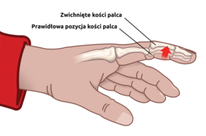 Zwichnięcie stawów palców ręki