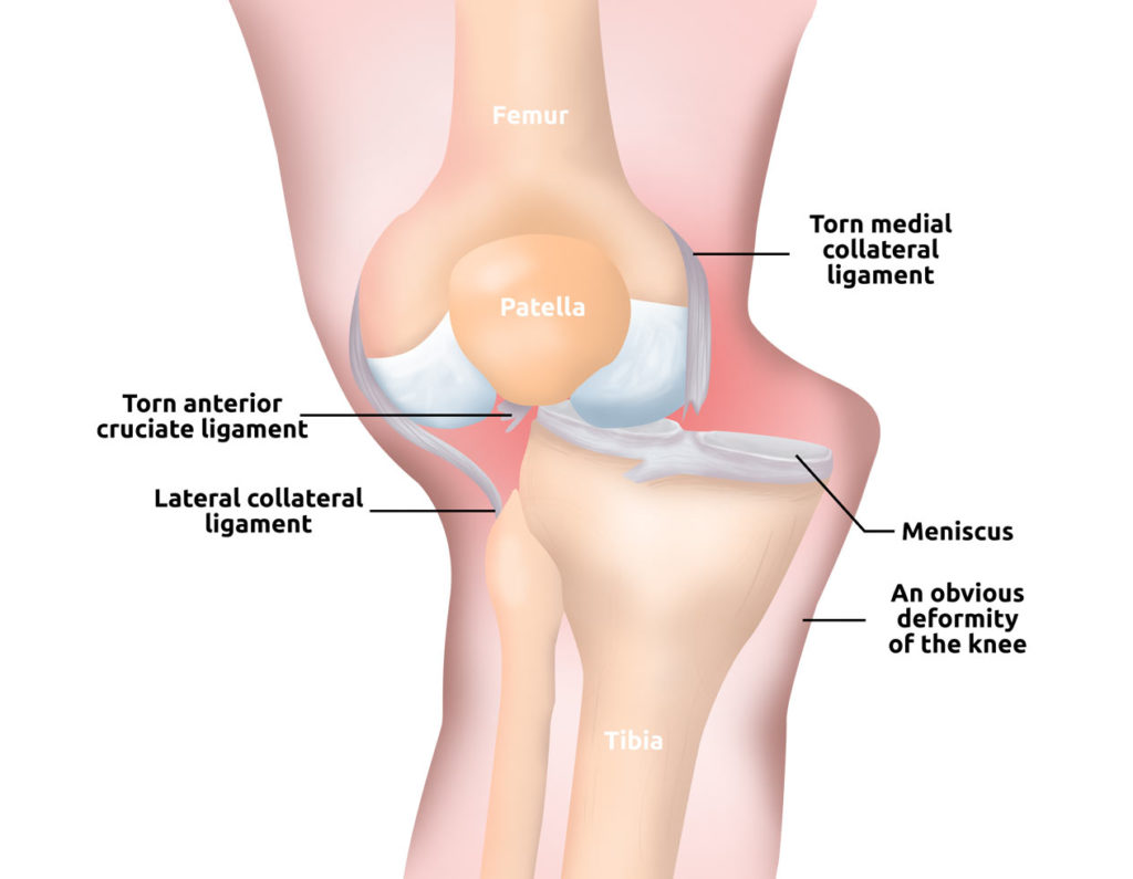 knee dislocation