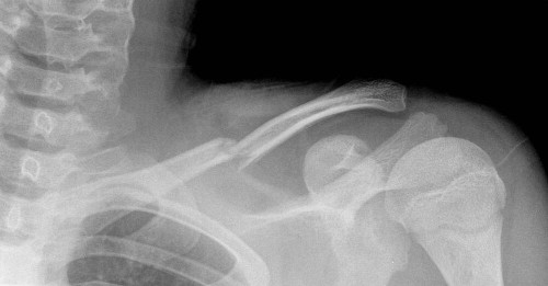 COLLARBONE FRACTURE